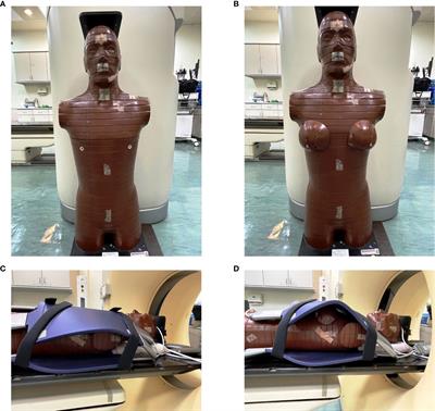 Electron stream effect in 0.35 Tesla magnetic resonance image guided radiotherapy for breast cancer